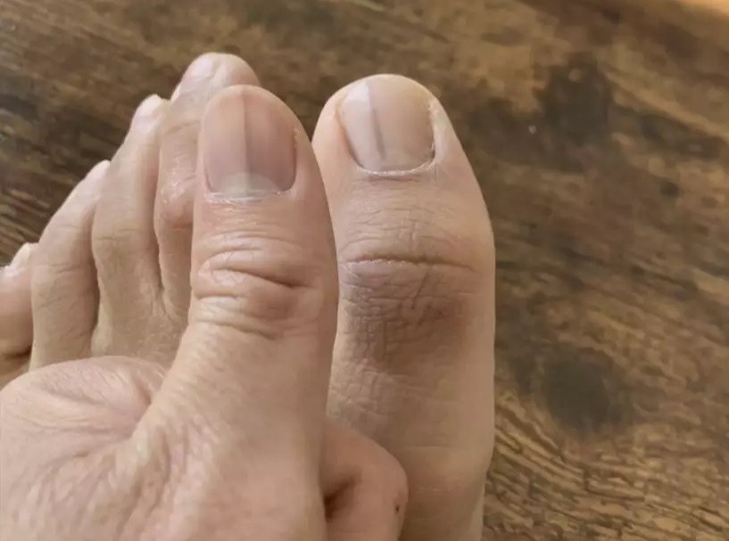 Dau hieu la tren mong chi bao mac ung thu nguy hiem hinh anh