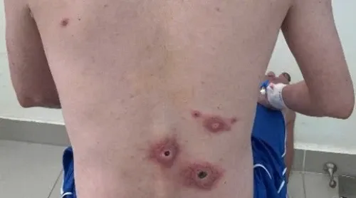 5 thac mac thuong gap nhat ve benh giang mai hinh anh