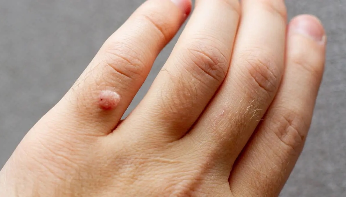 Duong lay truyen cua virus HPV hinh anh