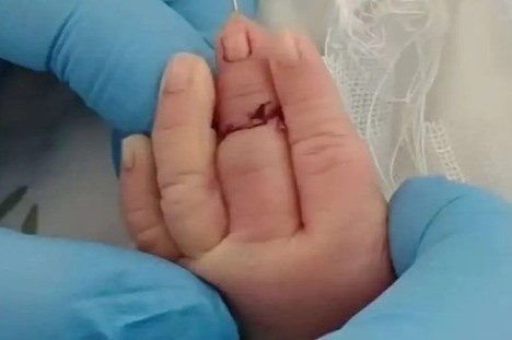 Nu y ta vo tinh cat dut ngon tay tre so sinh khi cat day ron hinh anh