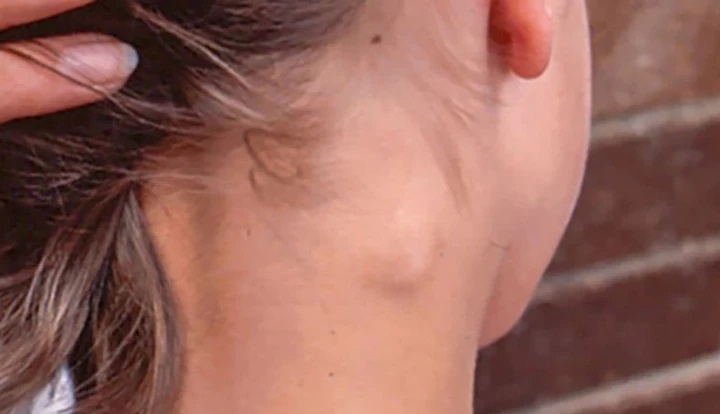 3 bat thuong o co canh bao ung thu, hay di kham bac si ngay lap tuc hinh anh