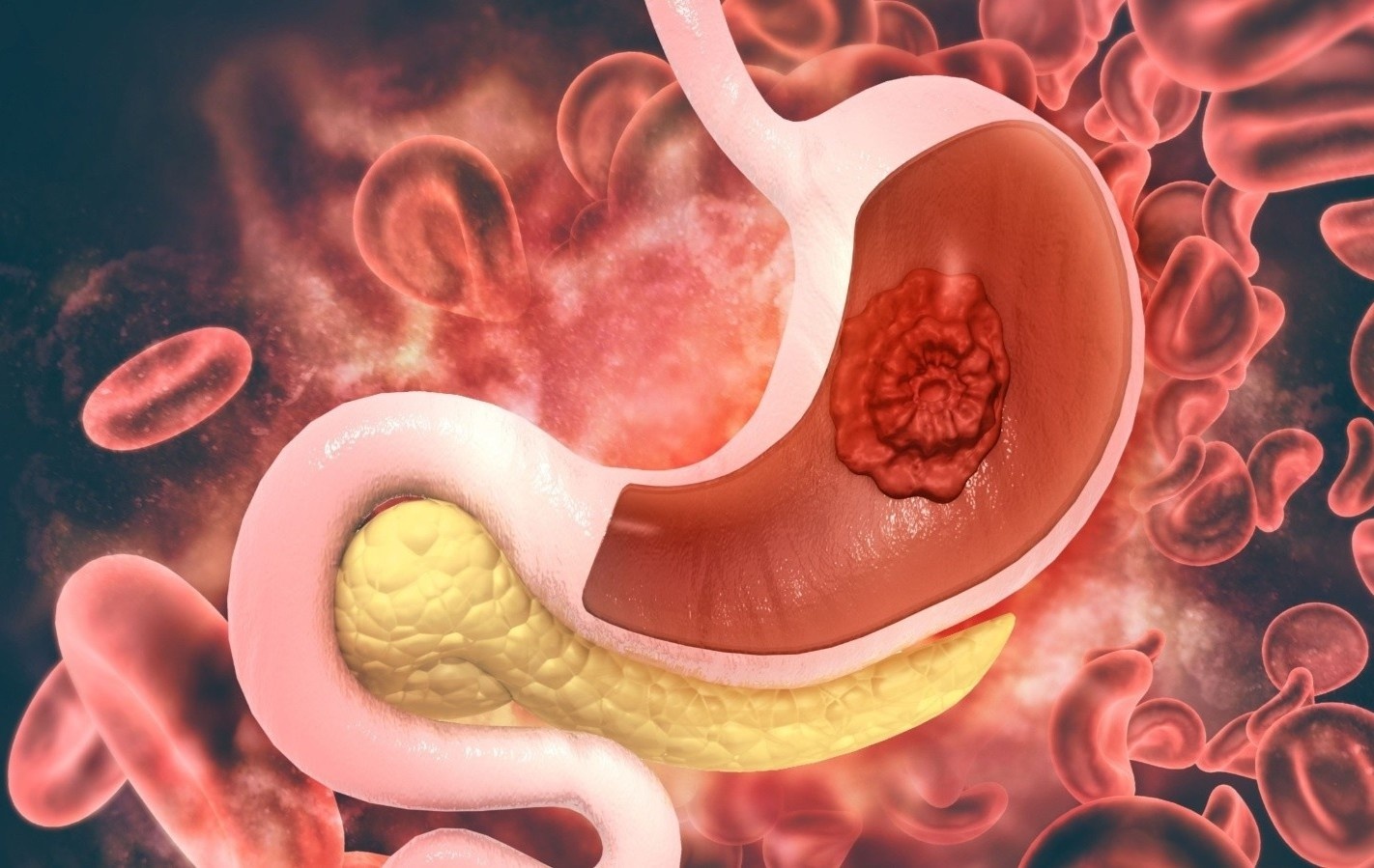 Ung thu da day nguy hiem va dien bien nhanh: Ai co nguy co mac? hinh anh