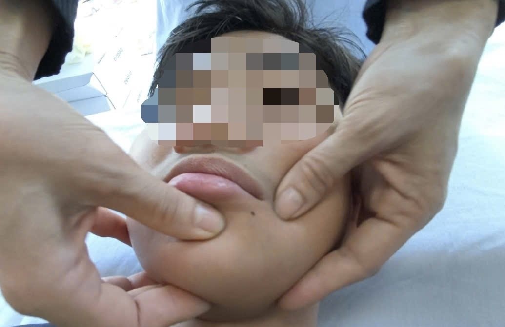 Nhieu nguoi nhap vien vi meo mieng, mat trai khong nham kin hinh anh