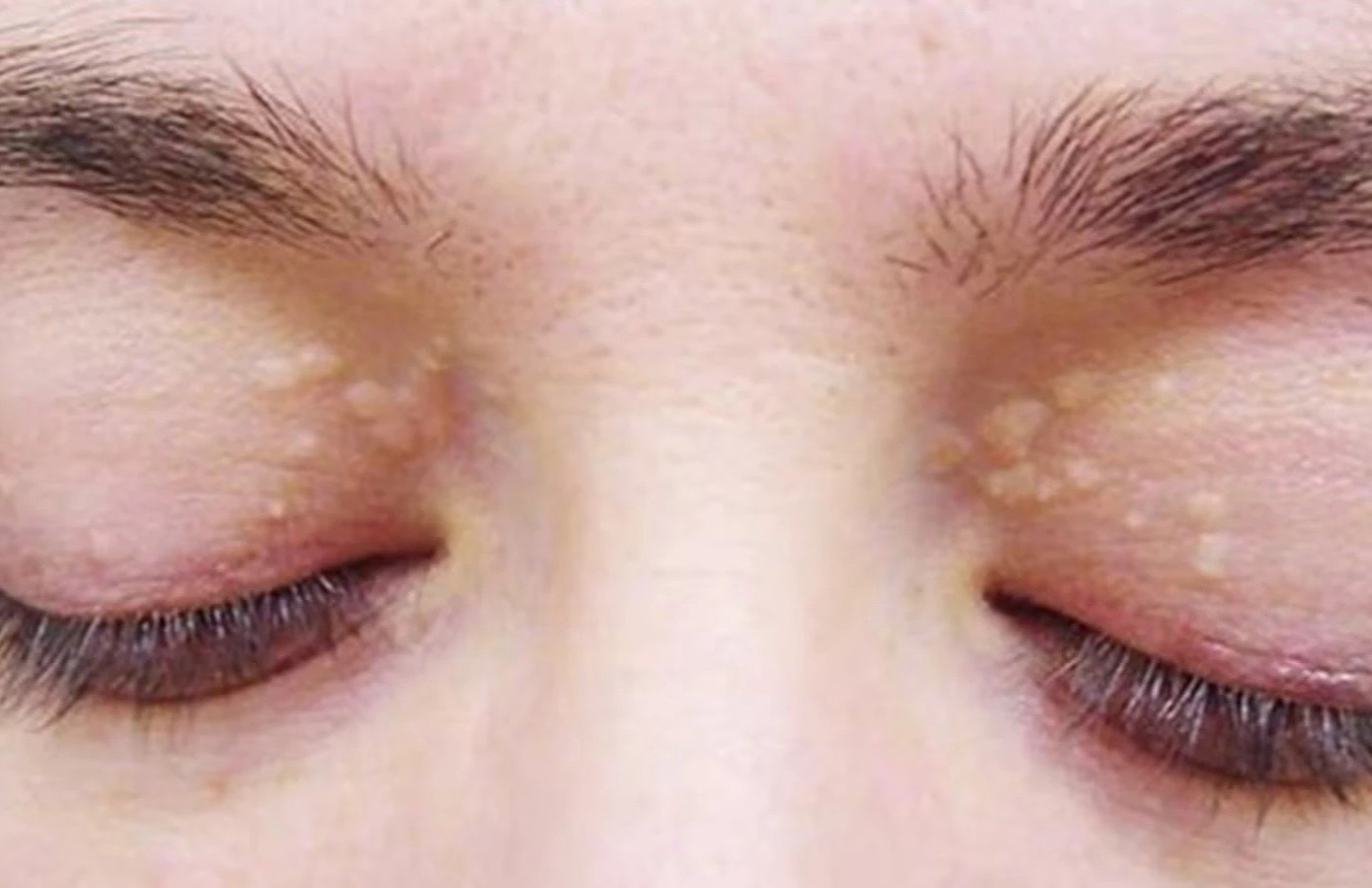 Trieu chung mo mau o muc nguy hiem xuat hien tren da hinh anh