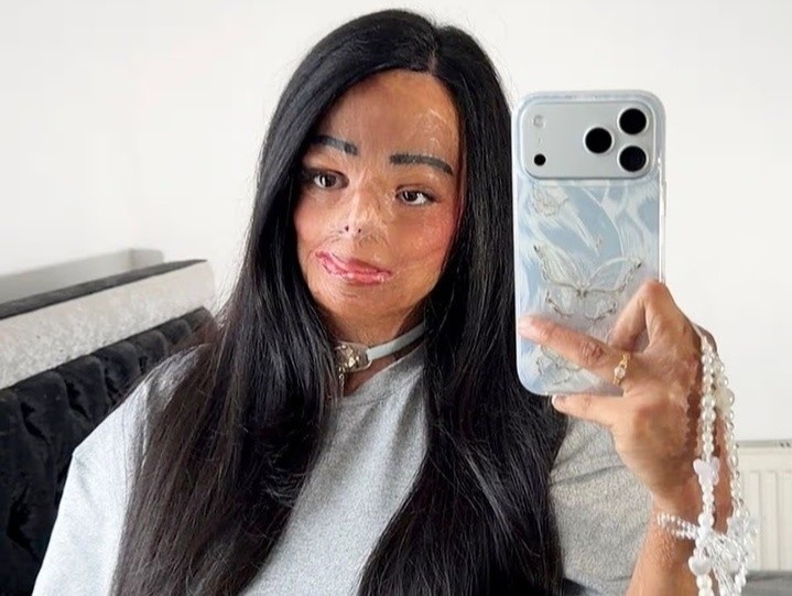 Dau goi dau bat lua, co gai bi bong nua nguoi va mat 7 ngon tay hinh anh