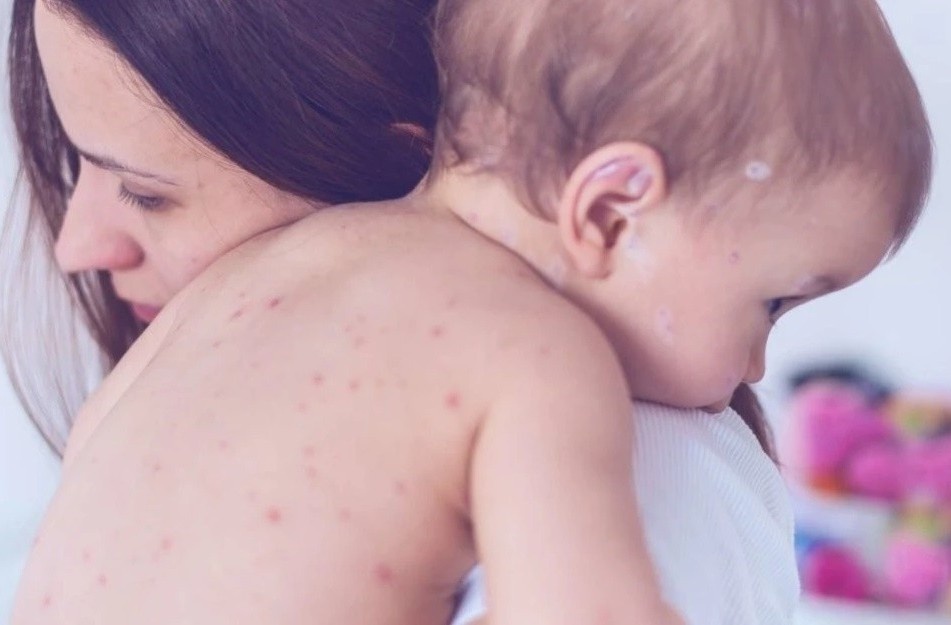 Tre bi thuy dau an gi de nhanh khoi? hinh anh