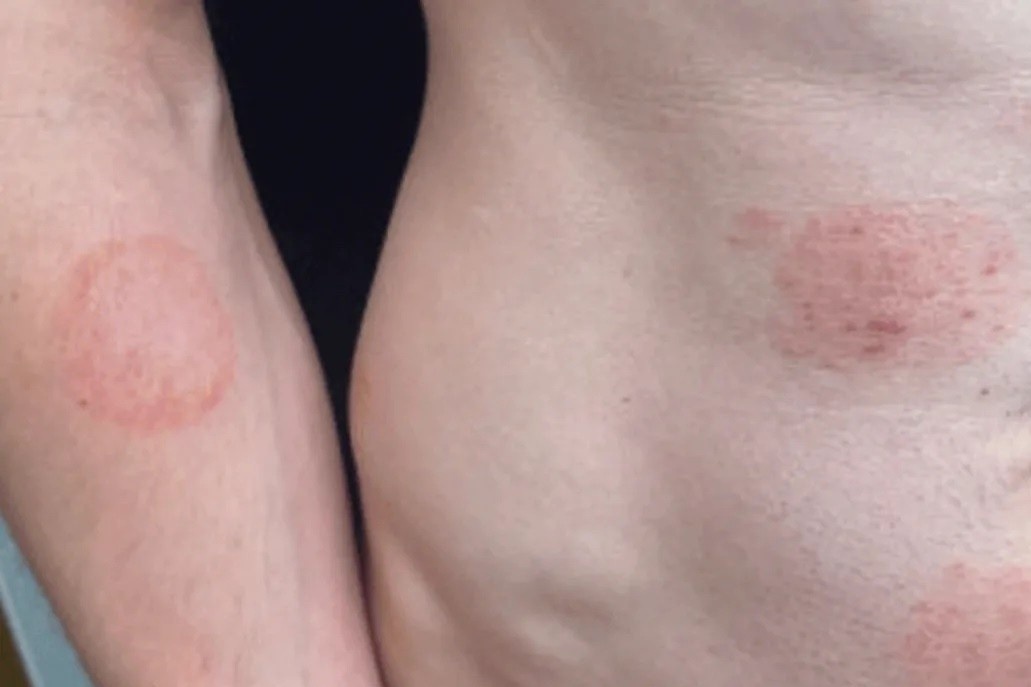 Mot benh lay truyen qua duong tinh duc dang lan rong o My hinh anh