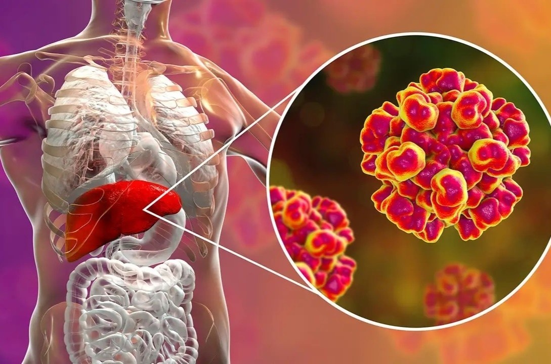 Duong lay va cach dieu tri viem gan E hinh anh