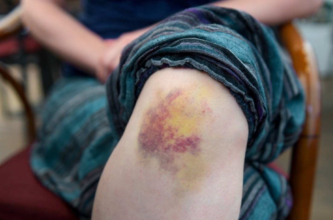 Dau hieu dien hinh tren da canh bao mac benh gan hinh anh