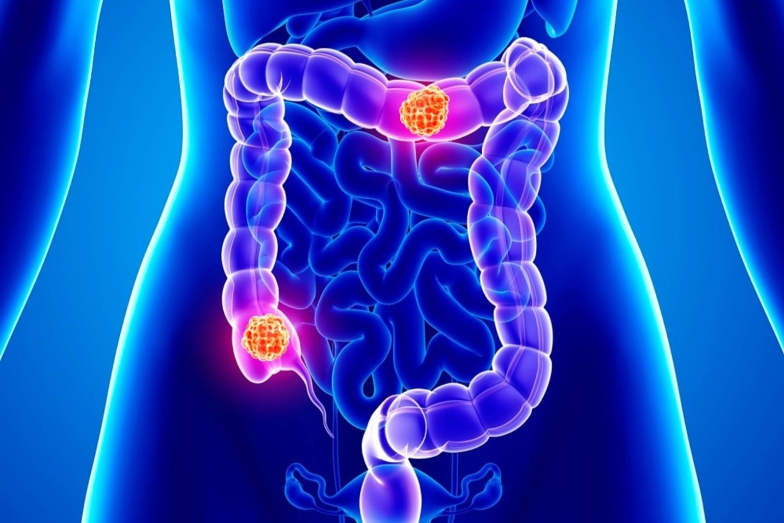 My canh bao benh ung thu gay tu vong so mot o nguoi duoi 50 tuoi hinh anh