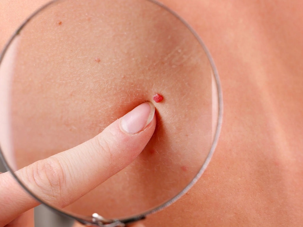 Dot ngot xuat hien not ruoi do tren da la dau hieu benh gi? hinh anh