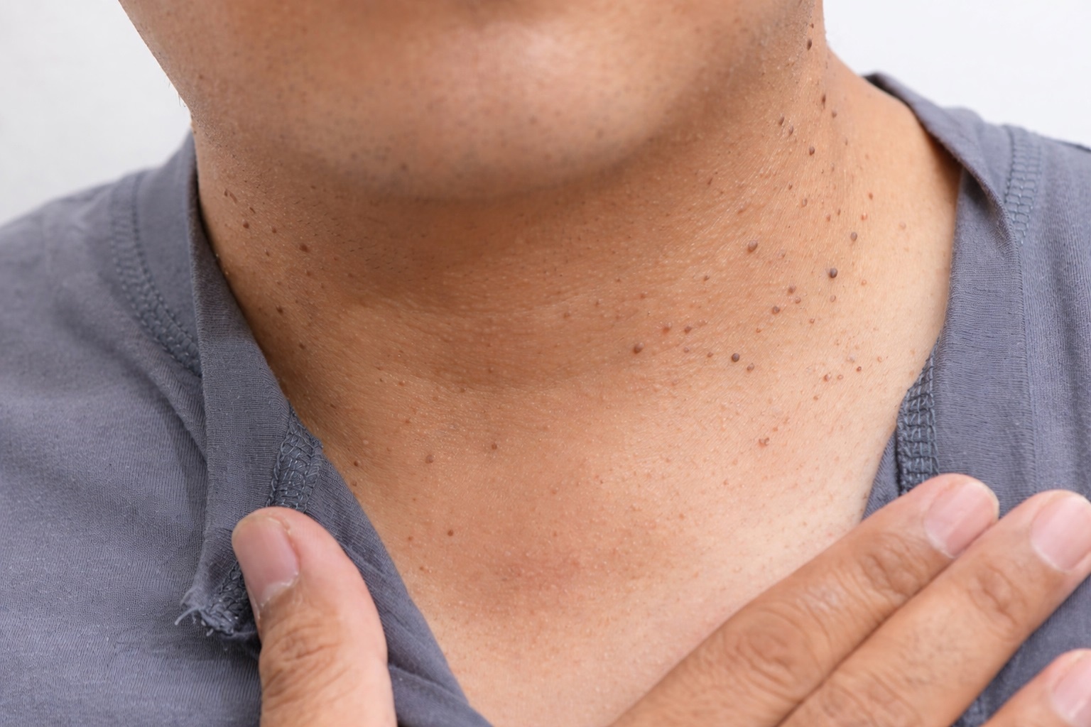 Khang insulin de gap o nguoi tre, gap 5 dau hieu nay can di kham som hinh anh