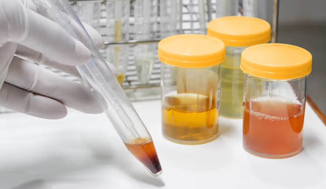 Bat thuong o nuoc tieu anh 2