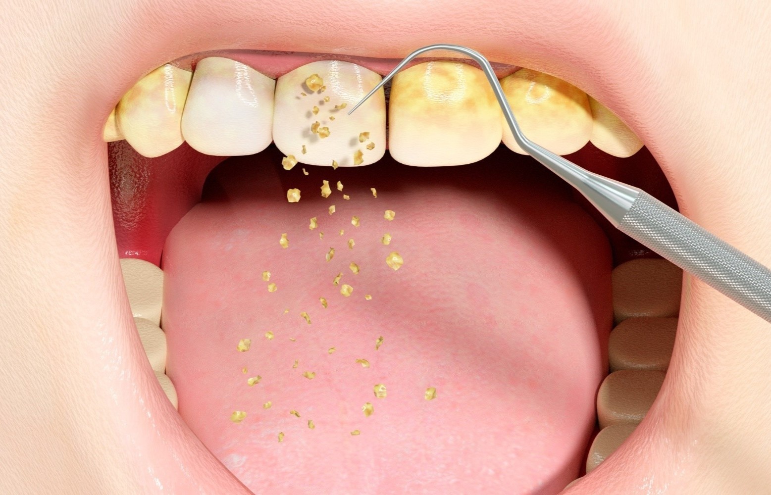 Dau hieu den luc can lay cao rang hinh anh