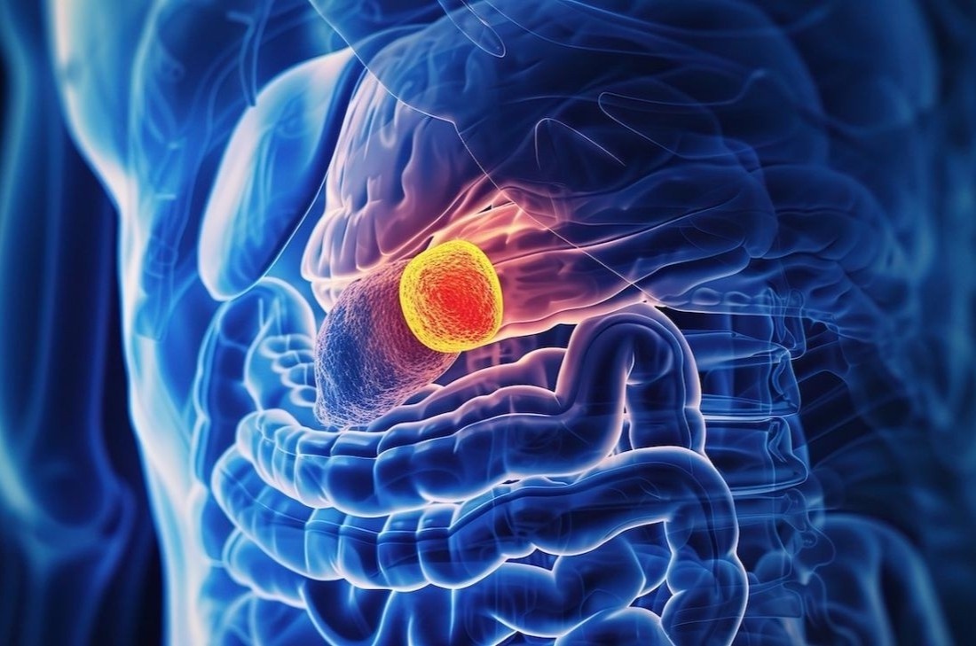 5 trieu chung canh bao ung thu tuyen tuy hinh anh