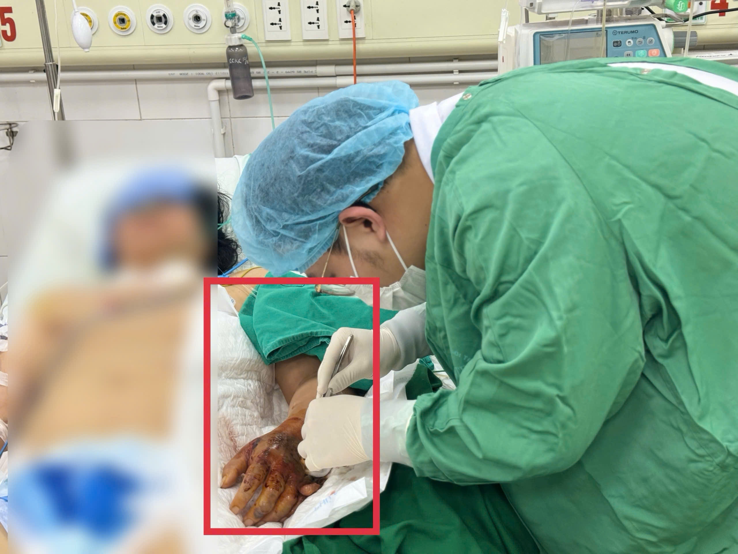 Vi khuan 'an thit' tan pha ban tay nguoi phu nu hinh anh