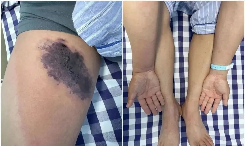 Nguoi dan ong bi nhen can gay hoai tu, nhiem doc toan than hinh anh