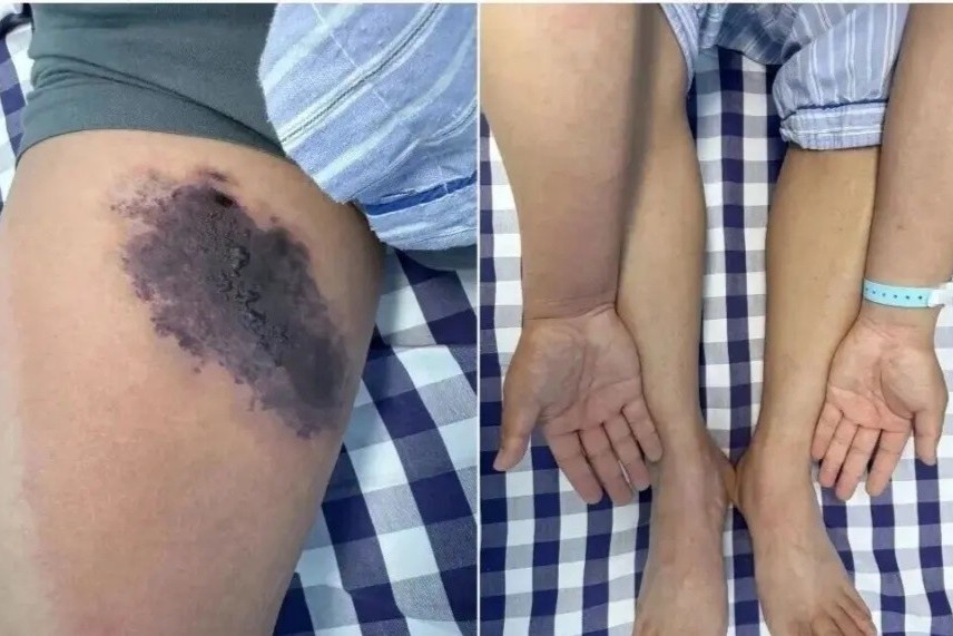 Nguoi dan ong bi nhen can gay hoai tu, nhiem doc toan than hinh anh