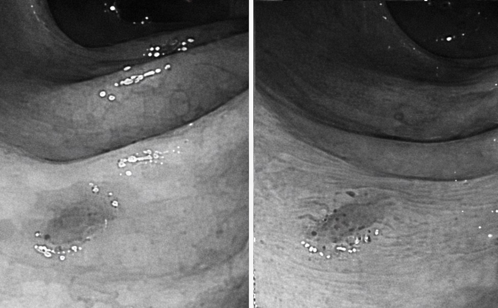 Be trai 12 tuoi mac ung thu dai truc trang giai doan cuoi hinh anh