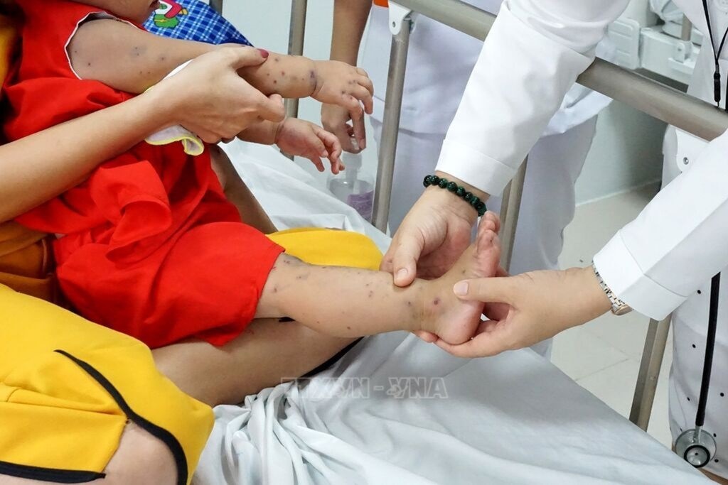 Lâm Đồng: Khẩn trương phòng chống sốt xuất huyết, tay chân miệng