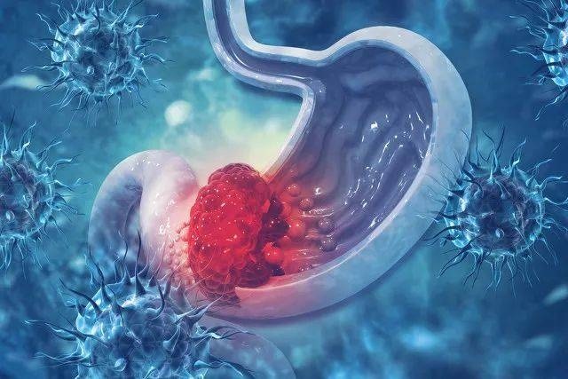 Phớt lờ dấu hiệu suốt nửa năm, người đàn ông mắc ung thư giai đoạn 3