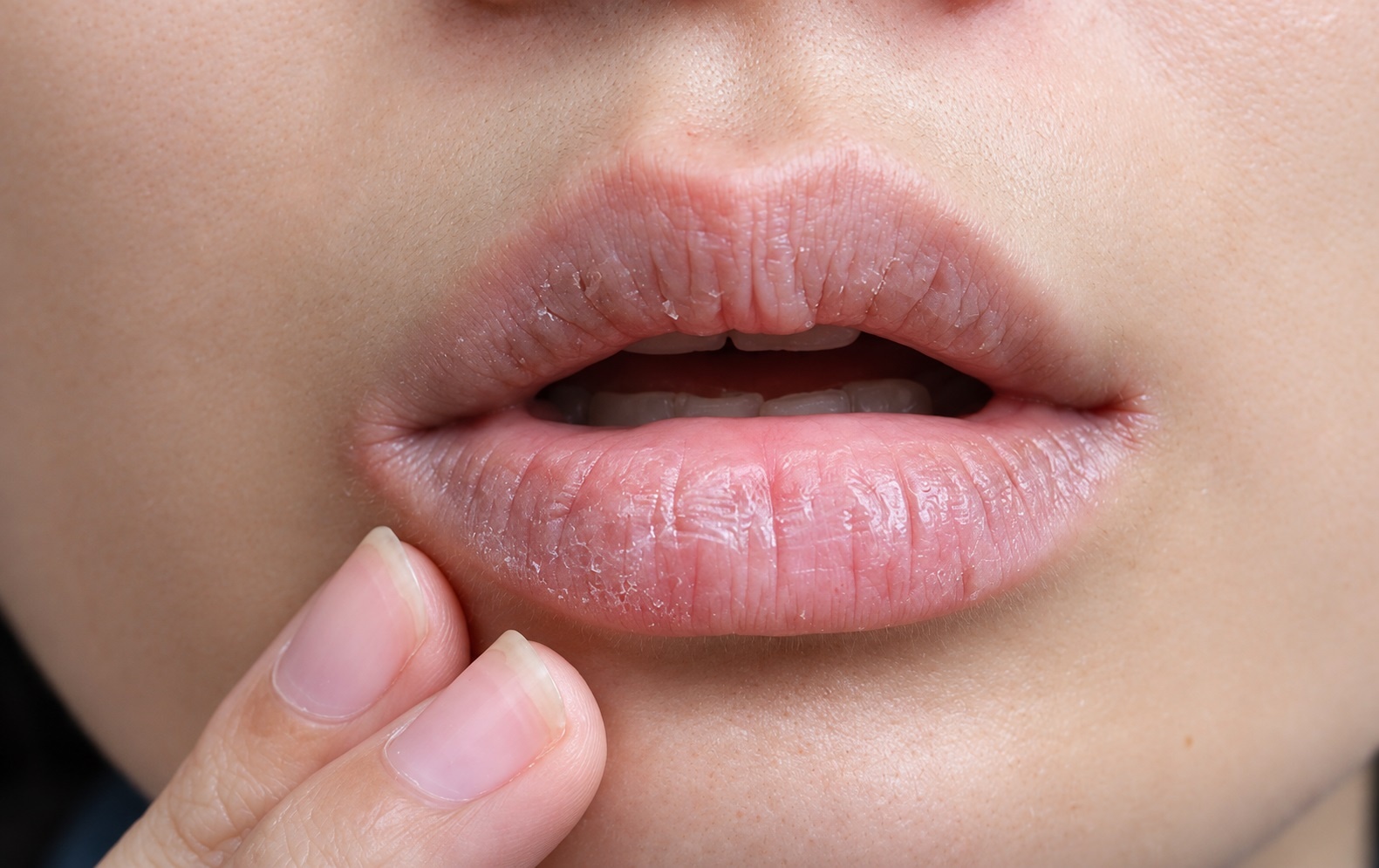 Dưỡng môi chăm chỉ nhưng miệng vẫn khô như sa mạc: Dấu hiệu 4 bệnh lý