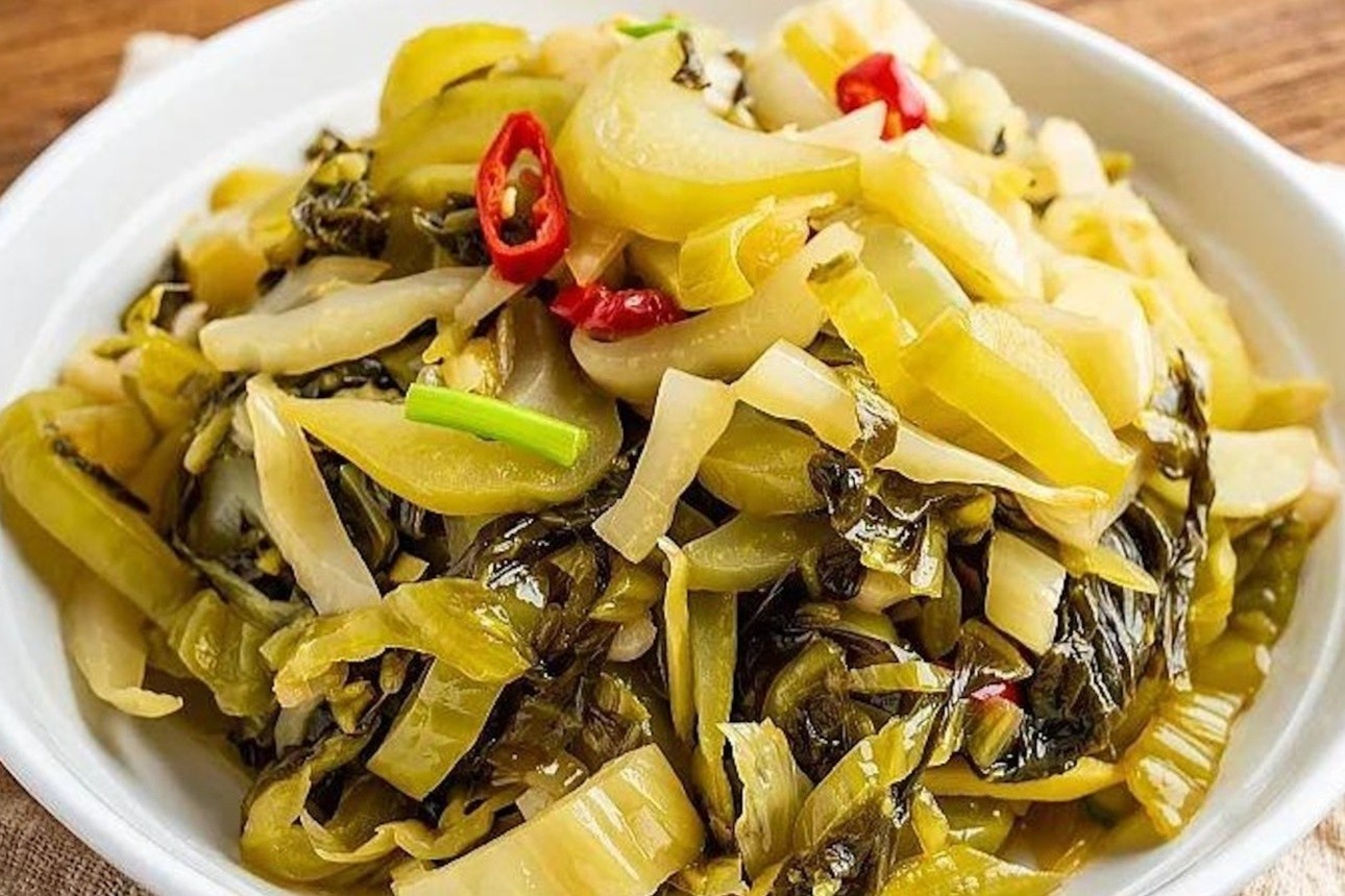 sỏi thận  ảnh 2