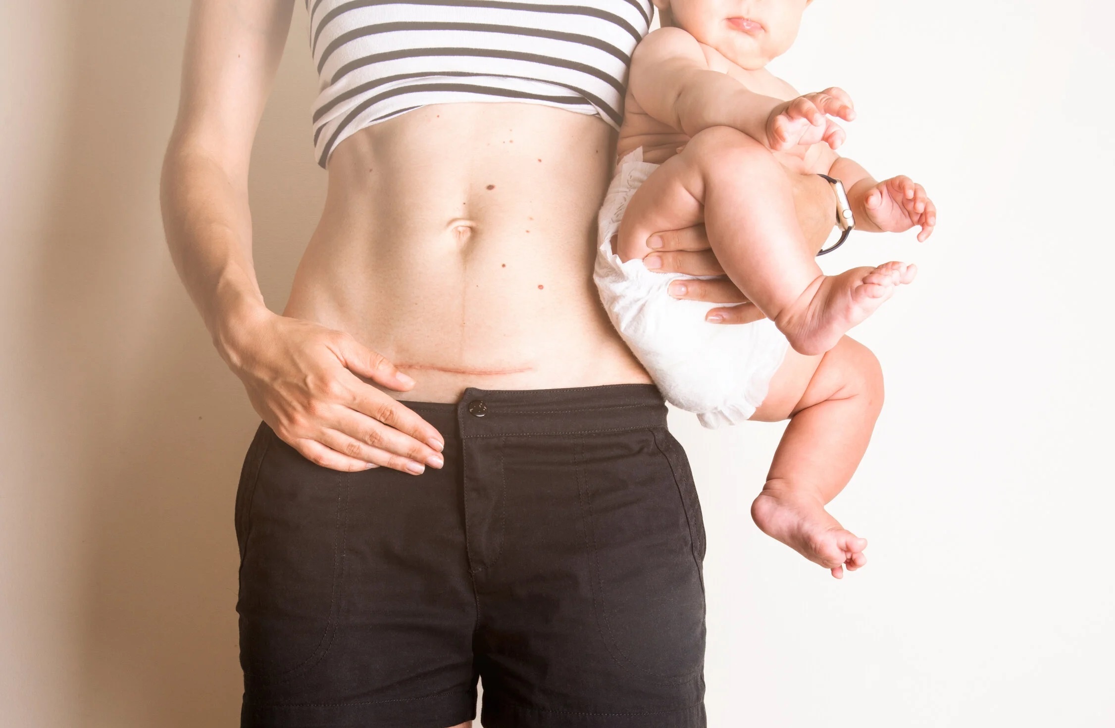 4 điều cần nhớ sau sinh mổ để cơ thể nhanh hồi phục