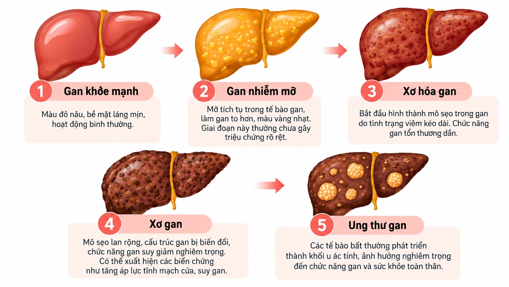 Gan nhiễm mỡ ảnh 3