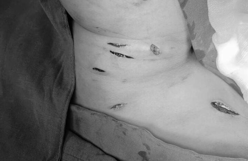 Cuu song benh nhan bi dam 19 nhat dao o Dak Lak hinh anh