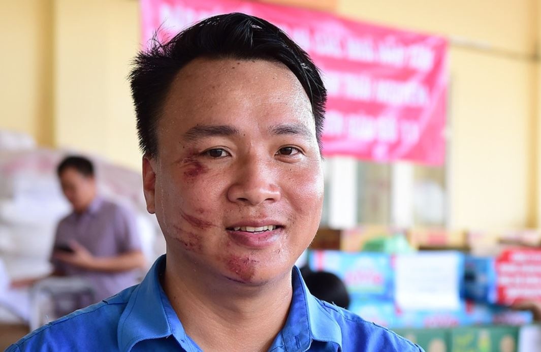 Vet thuong tren mat Bi thu doan phuong o 'ron lu' Thai Nguyen hinh anh