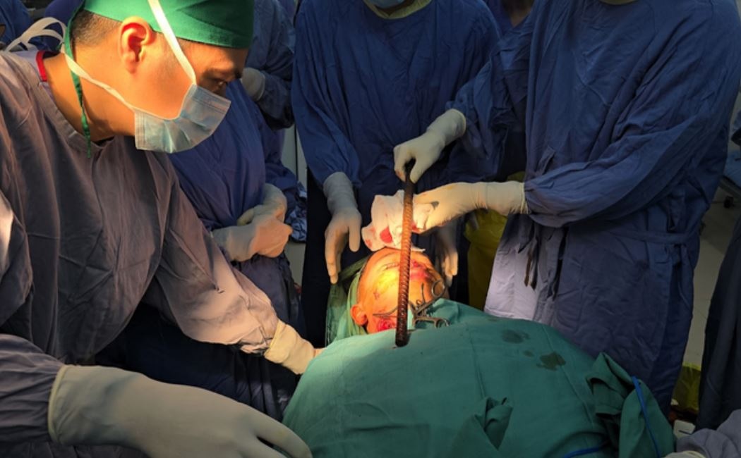 Nam sinh bi thanh sat dai 50 cm dam xuyen qua dau va mat hinh anh