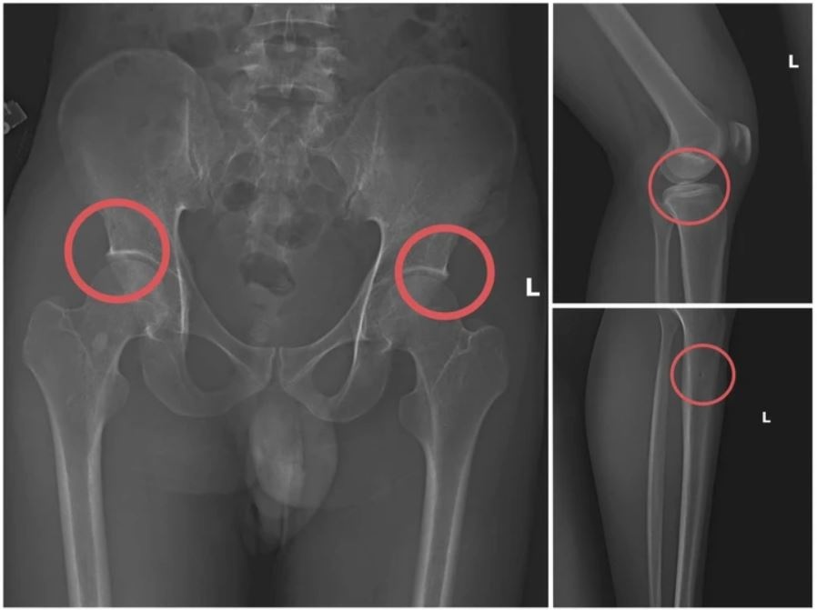 gay xuong lua bao hiem anh 2