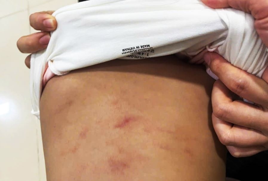 Be 2 tuoi nghi bi bao hanh tai lop trong tre o Ca Mau hinh anh