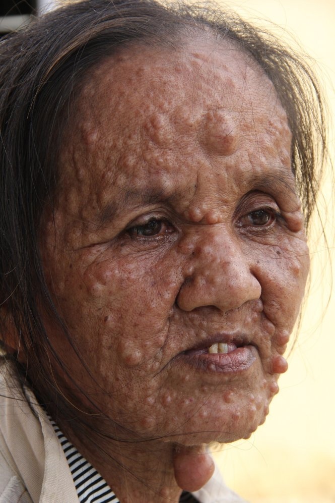 Nguoi phu nu voi nhung khoi u hinh anh