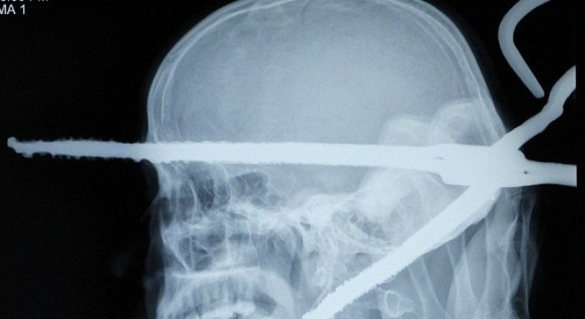 Song sot than ky sau khi bi kep than xuyen qua dau hinh anh