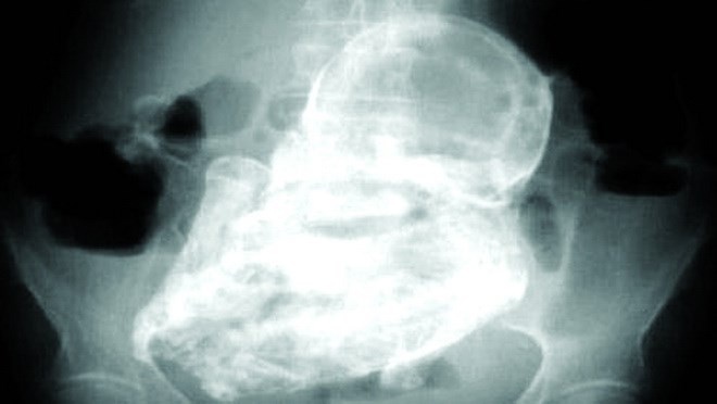 Hop so bao thai nam trong bung me 38 nam hinh anh