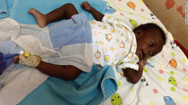 Cat bo tu chi cua thai nhi song sinh tren co the be trai hinh anh