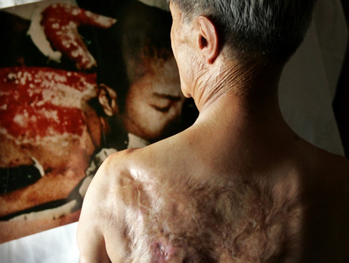 Nhung thai nhi di tat vi bom nguyen tu am anh bac si My hinh anh