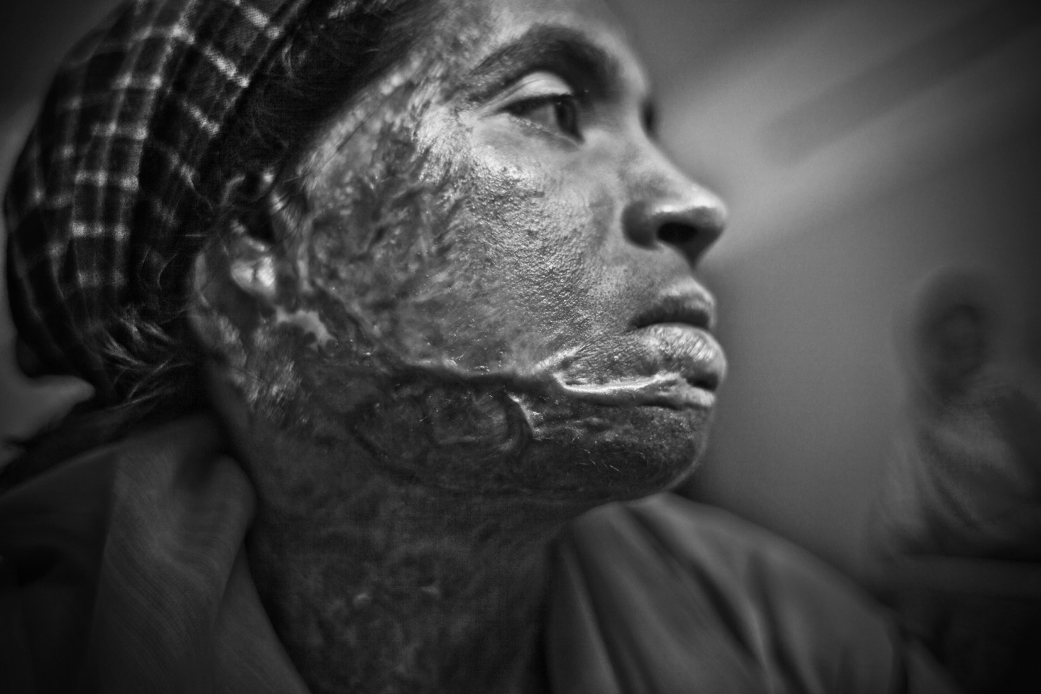 Noi dau axit tren co the nhung co gai tre Bangladesh hinh anh