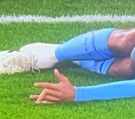 Nunes chan thuong anh 1