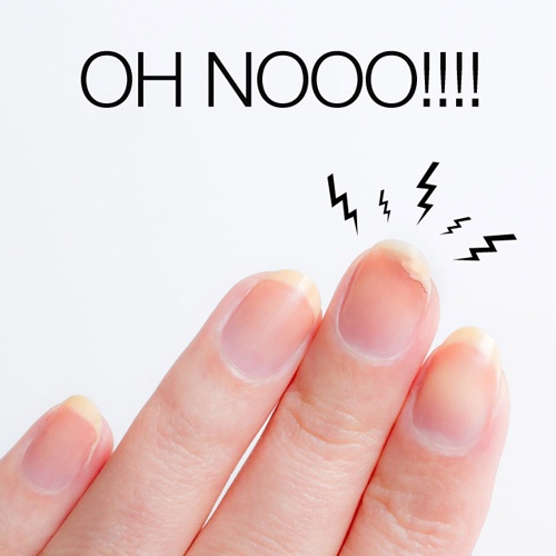 Lam gi khi mong tay bi gay hinh anh