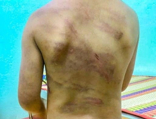 Be gai 7 tuoi chi chit vet thuong tren nguoi, nghi bi bao hanh hinh anh