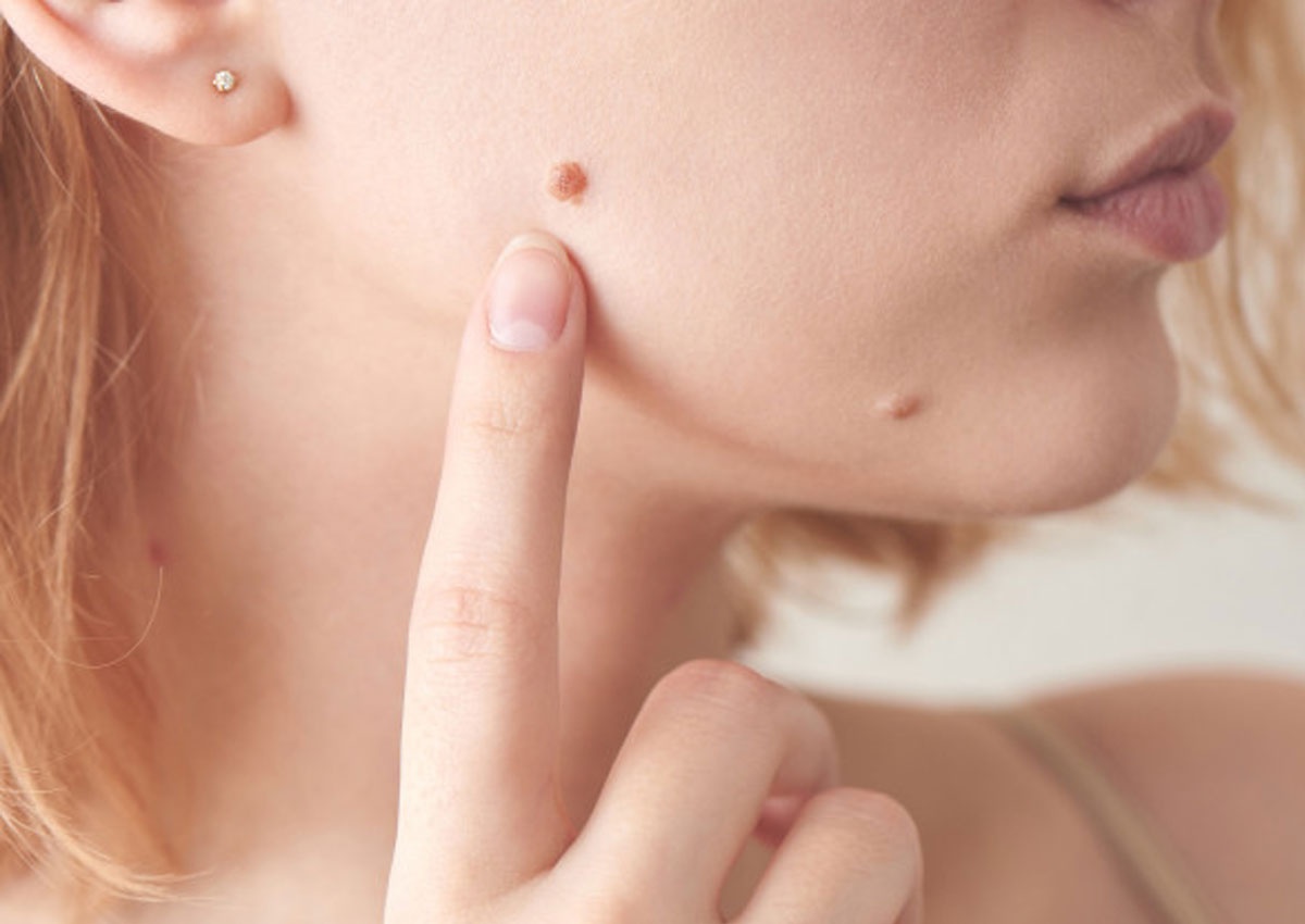 Cach tri mun coc hieu qua tai nha hinh anh