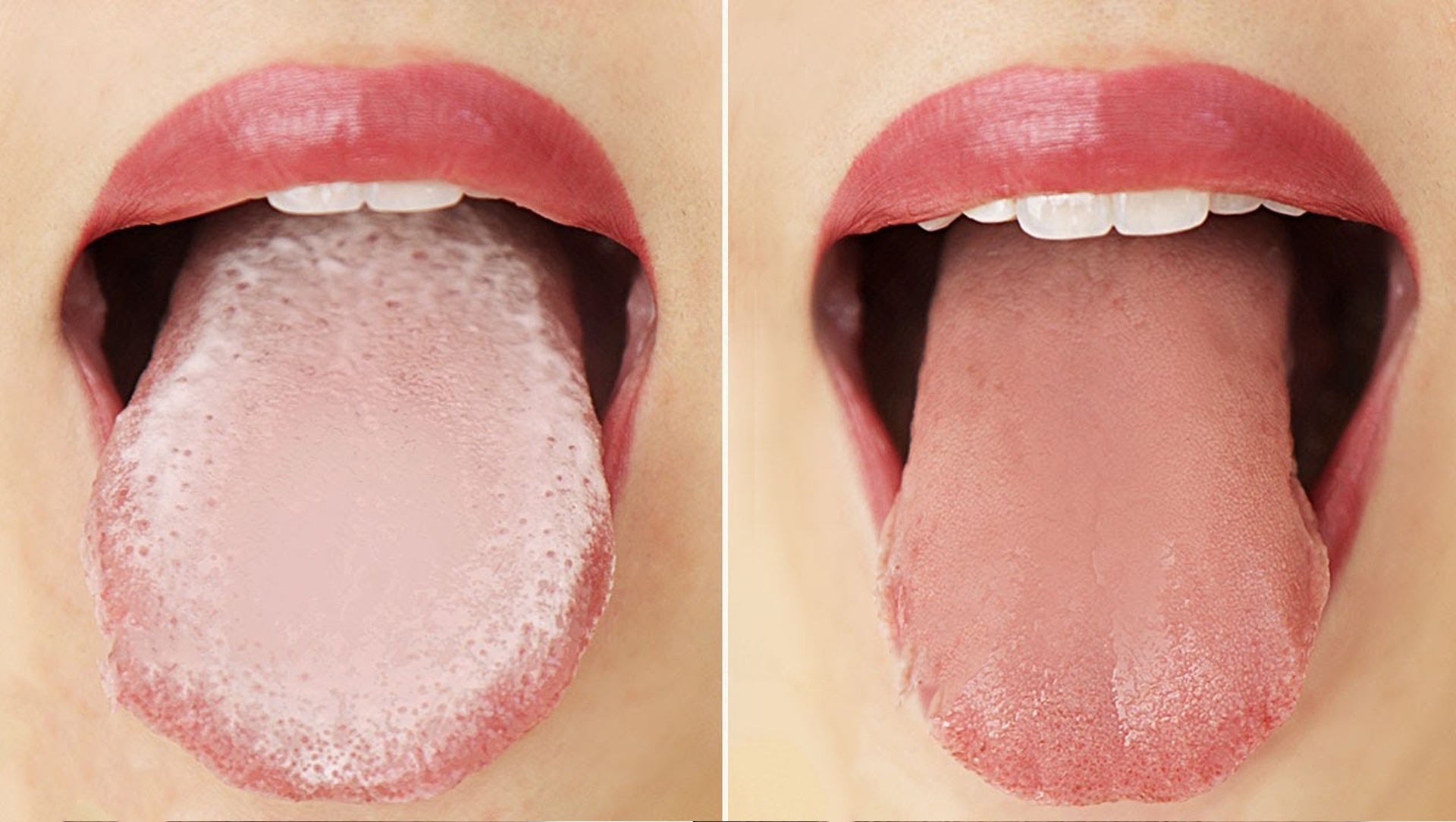 9 cach tri hoi mieng hieu qua tuc thi hinh anh