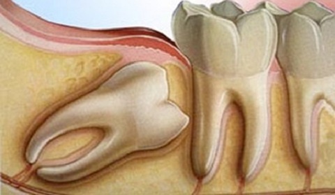 Tử vong vì mọc răng khôn ảnh 1 Tu vong vi moc rang khon anh 1