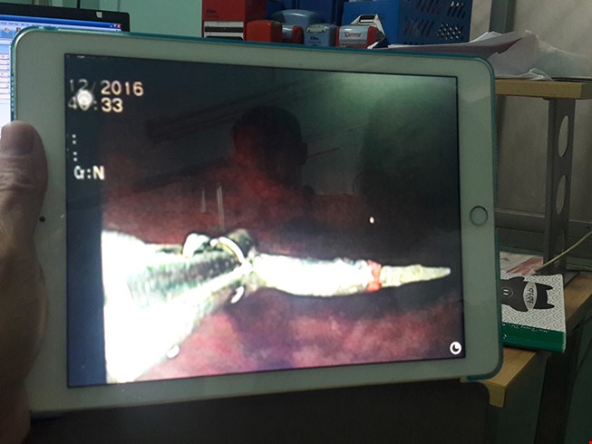 Nuốt phải mũi khoan khi khám răng ảnh 2 Nuot phai mui khoan khi kham rang anh 2