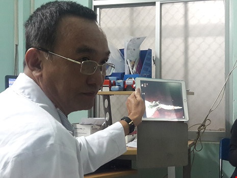 Nuốt phải mũi khoan khi khám răng ảnh 1 Nuot phai mui khoan khi kham rang anh 1