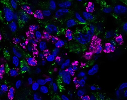 Phòng chống bệnh ung thư não ảnh 2 Phong chong benh ung thu nao anh 2