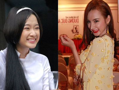 My nhan Viet 'meo mo' sau phau thuat tham my hinh anh